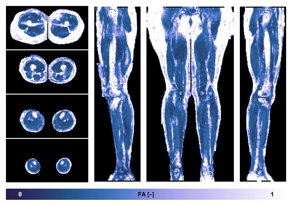 IVIM corrected whole leg muscle fractional anisotropy obtained from diffusion tensor imaging.